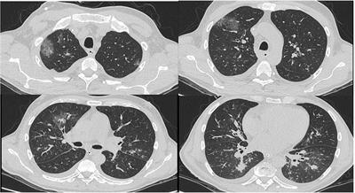 Case Report: Invasive Fungal Infection and Daratumumab: A Case Series and Review of Literature